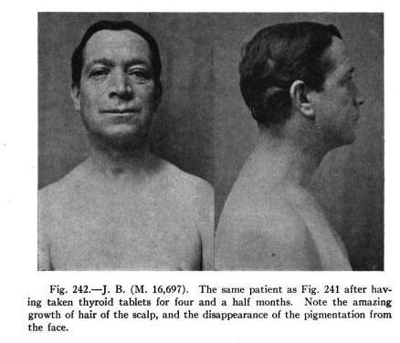 lugol's iodine for hypothyroidism